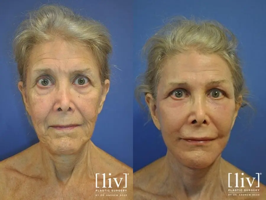 Facelift & Neck Lift: Patient 8 - Before and After 1