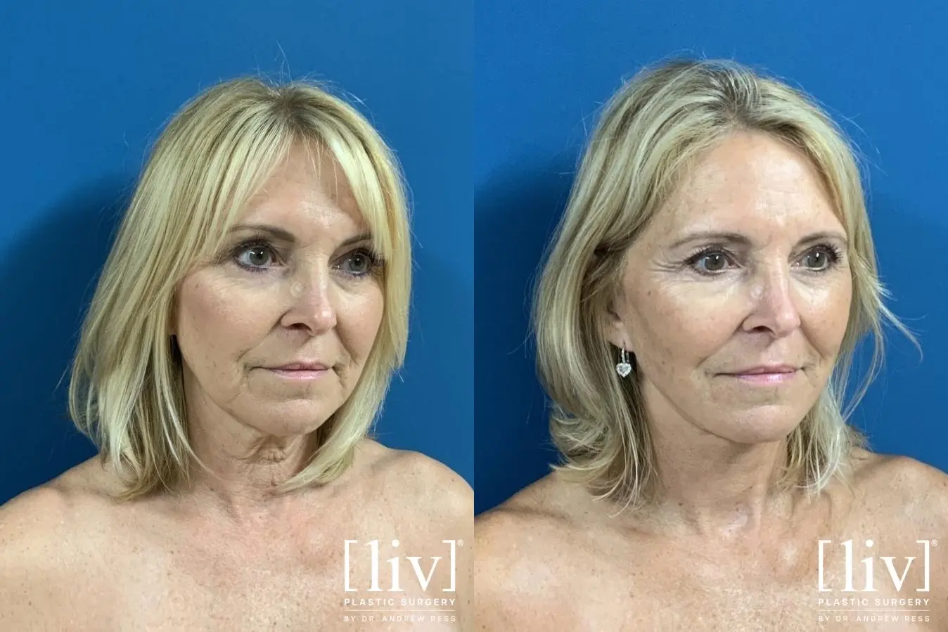 Facelift & Neck Lift: Patient 3 - Before and After 4