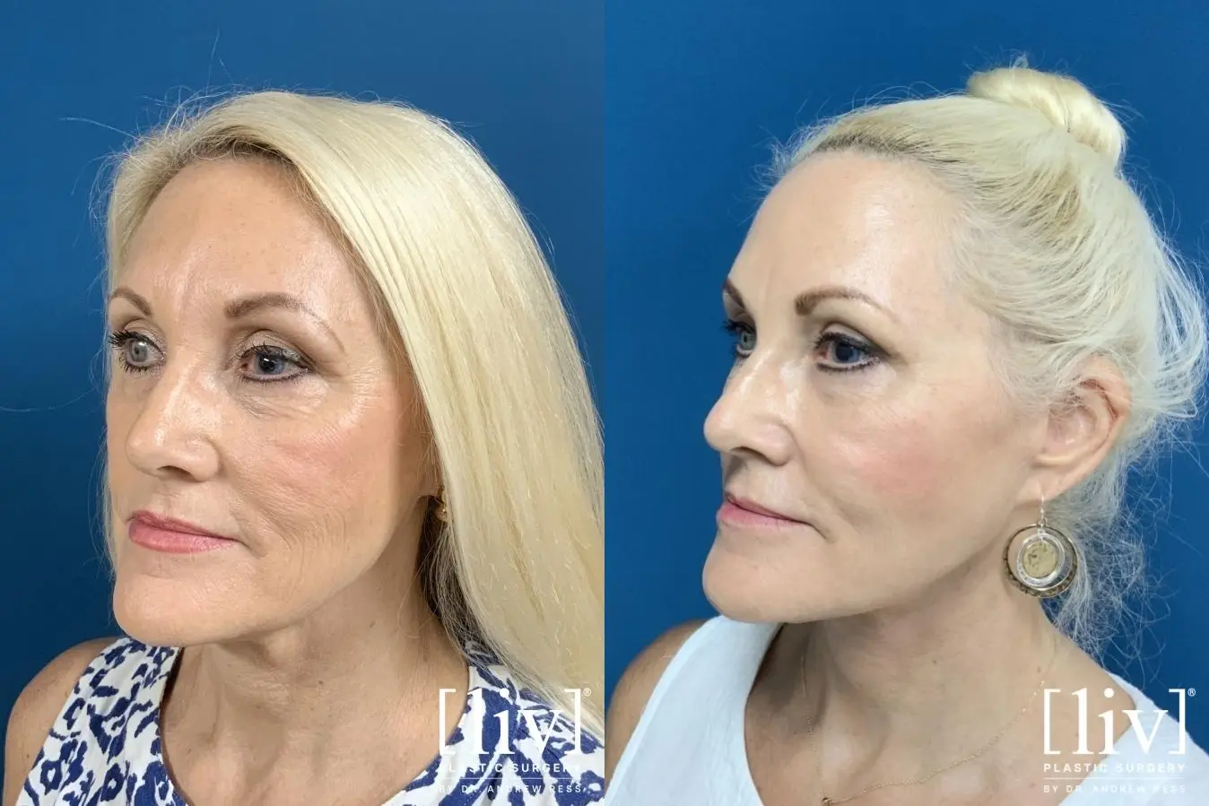 Facelift & Neck Lift: Patient 6 - Before and After 2