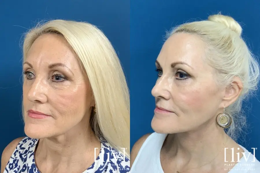 Facelift & Neck Lift: Patient 5 - Before and After 2