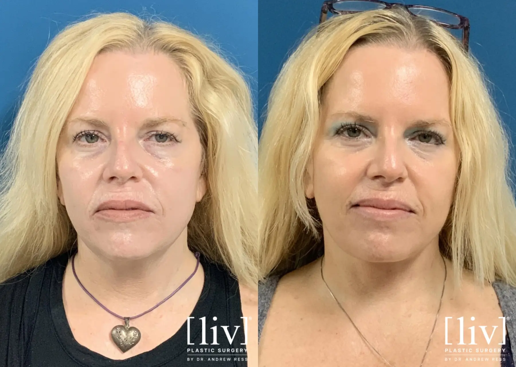 Facelift & Neck Lift: Patient 20 - Before and After 3