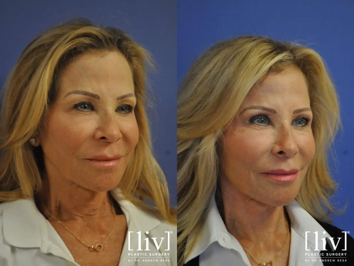 Facelift & Neck Lift: Patient 7 - Before and After 2