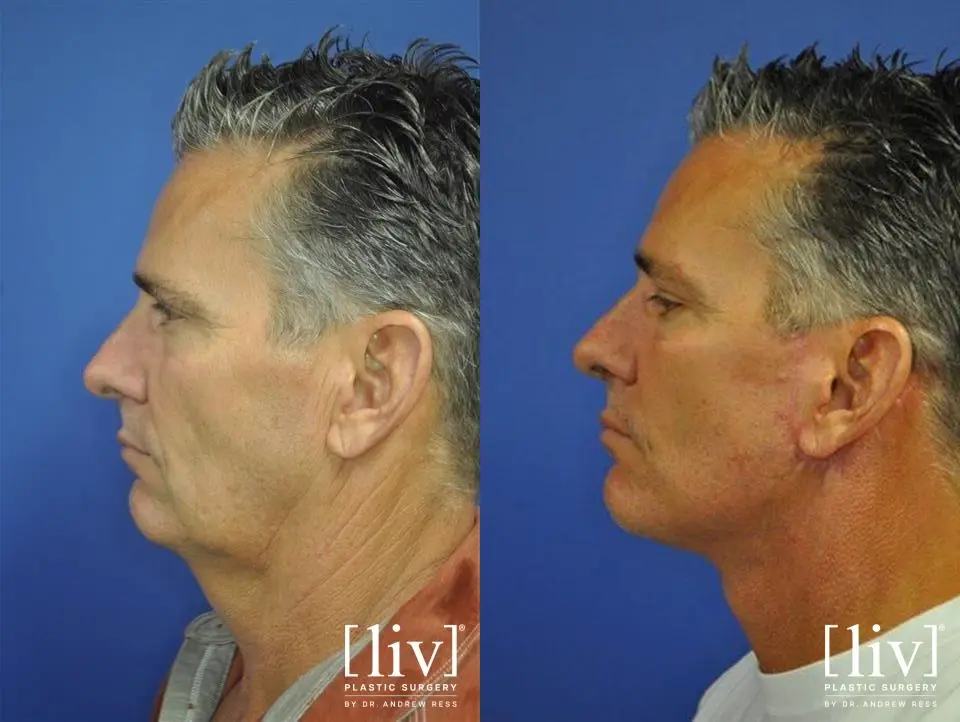 Facelift & Neck Lift: Patient 8 - Before and After 2