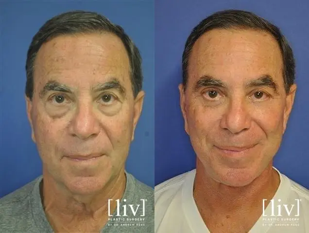 Facelift & Neck Lift: Patient 14 - Before and After 1