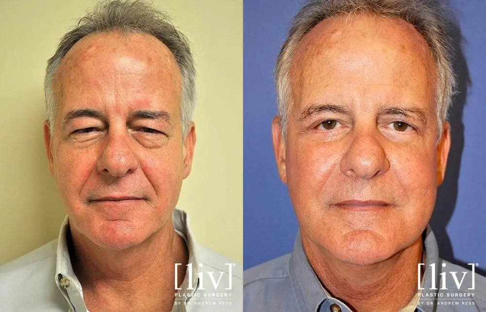 Facelift & Neck Lift: Patient 13 - Before and After 1