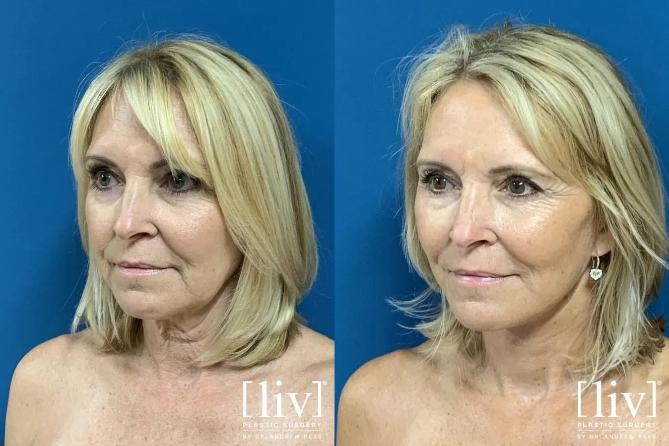 Facelift & Neck Lift: Patient 3 - Before and After 2
