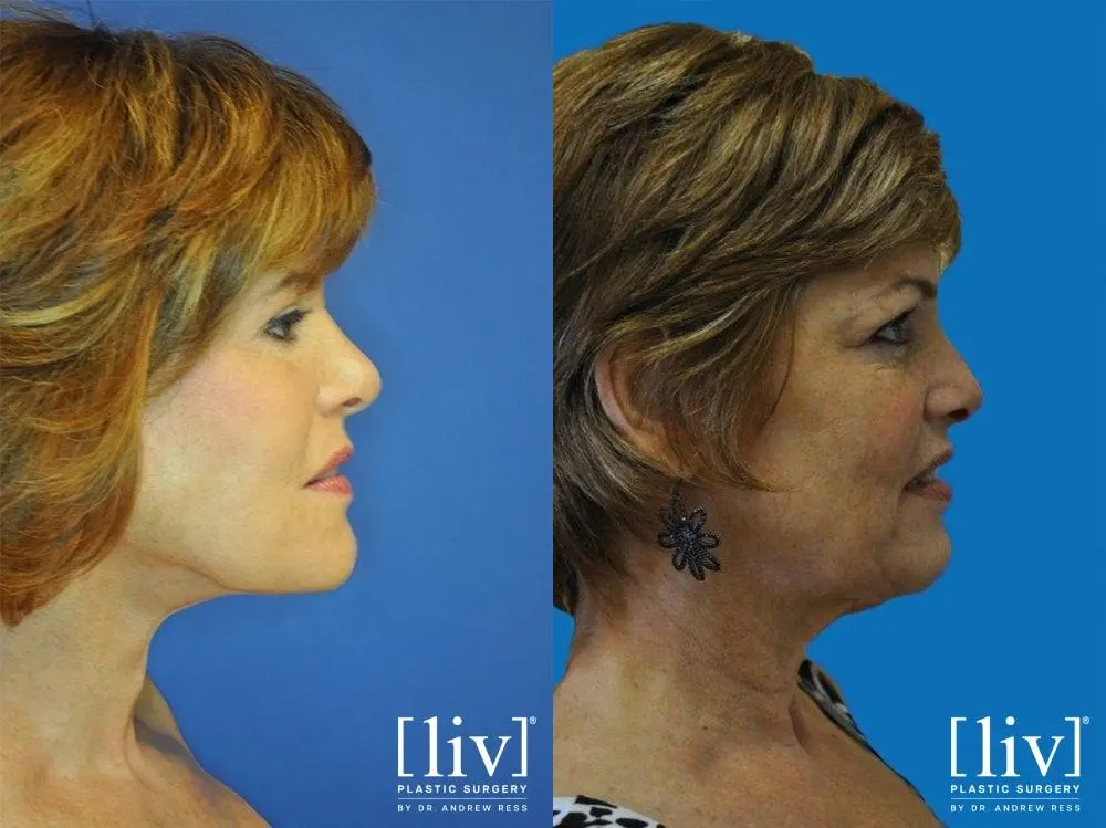 Facelift & Neck Lift: Patient 17 - Before and After 3
