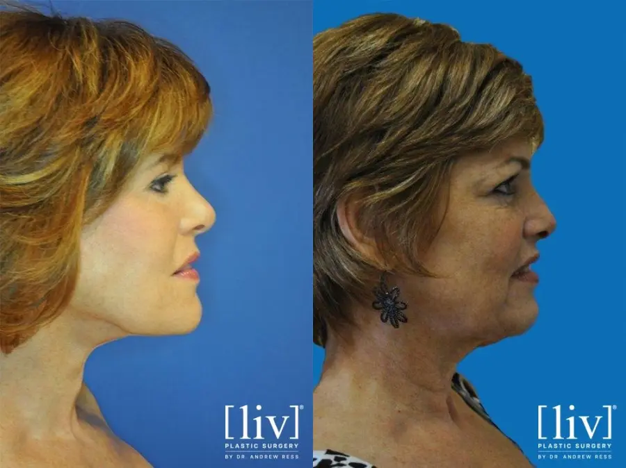 Facelift & Neck Lift: Patient 10 - Before and After 3