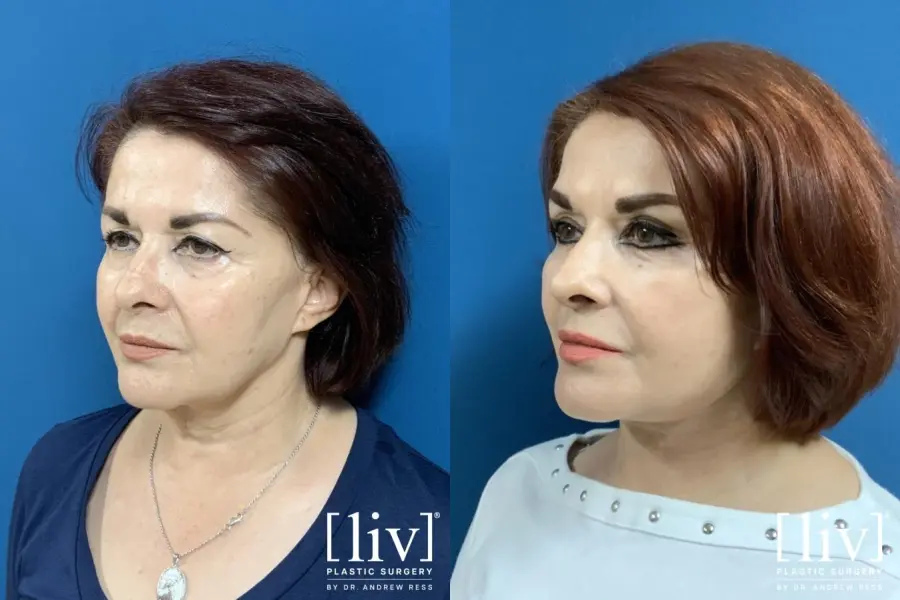 Facelift & Neck Lift: Patient 2 - Before and After 2