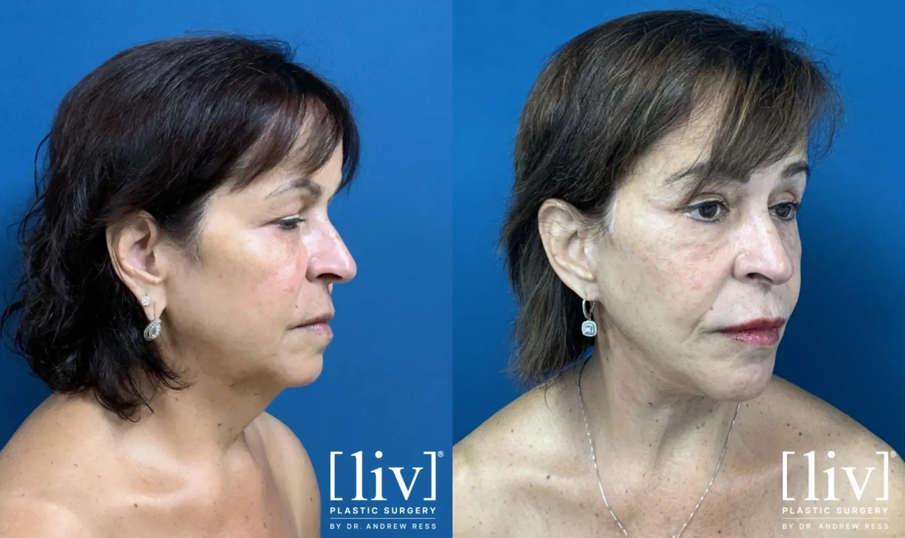 Facelift & Neck Lift: Patient 10 - Before and After 4