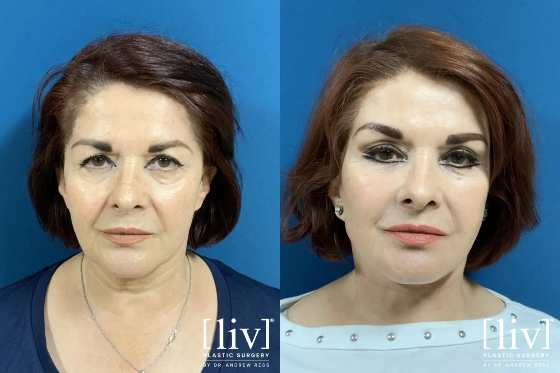 Facelift & Neck Lift: Patient 2 - Before and After 1