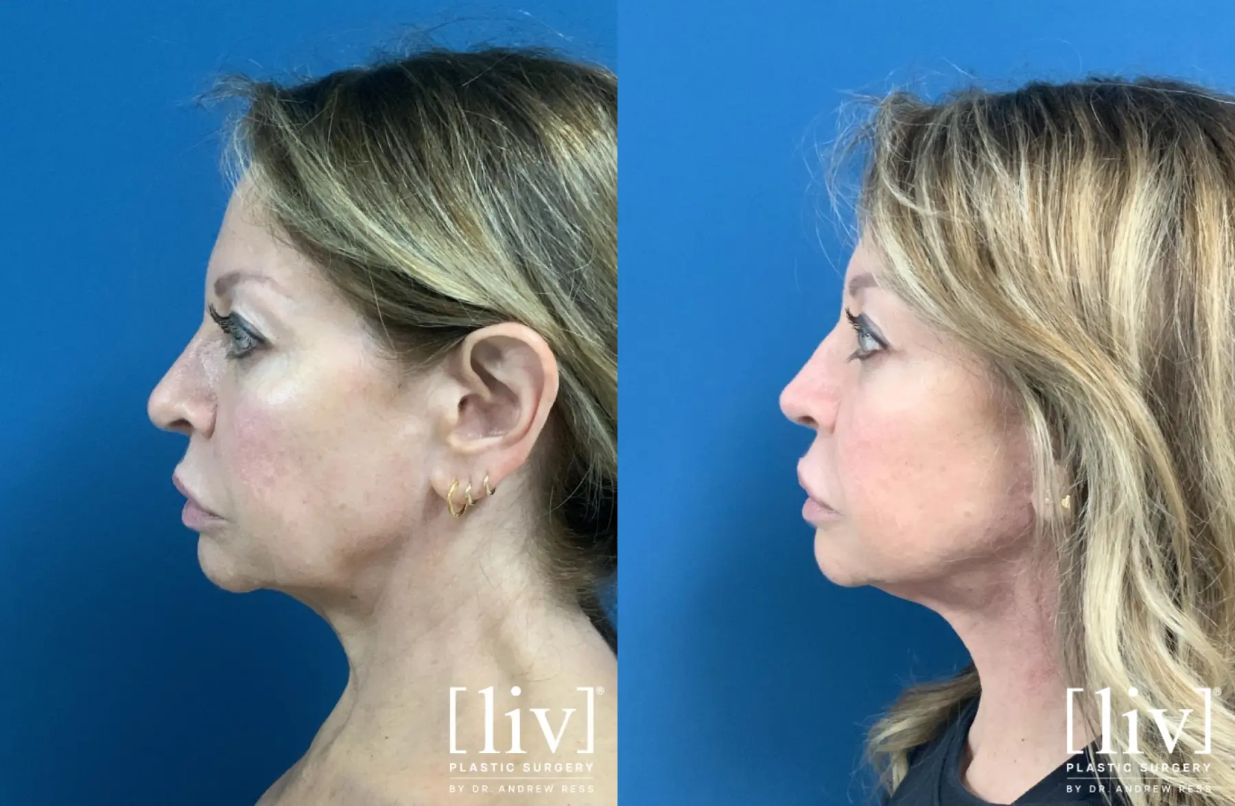 Neck Lift with CO2 Laser  - Before and After 1