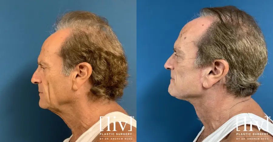 Facelift & Neck Lift: Patient 13 - Before and After 1