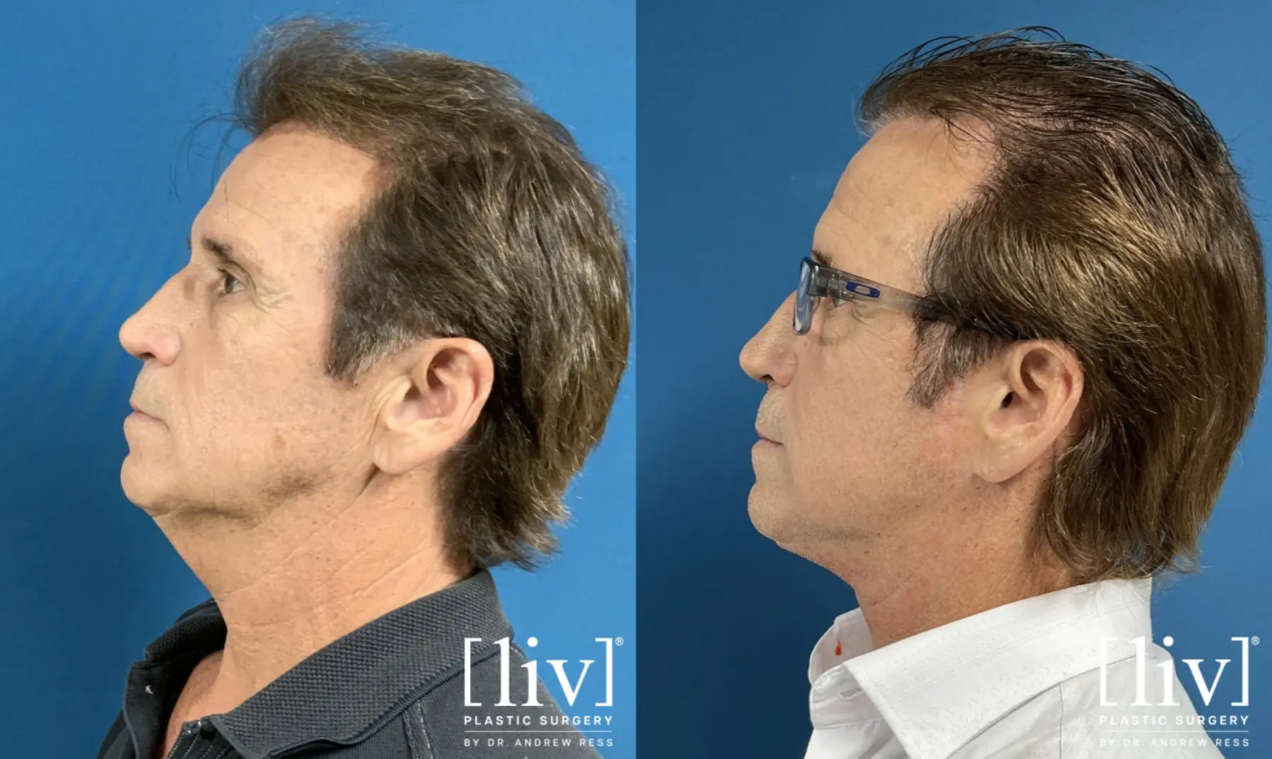 Neck Lift  - Before and After 2