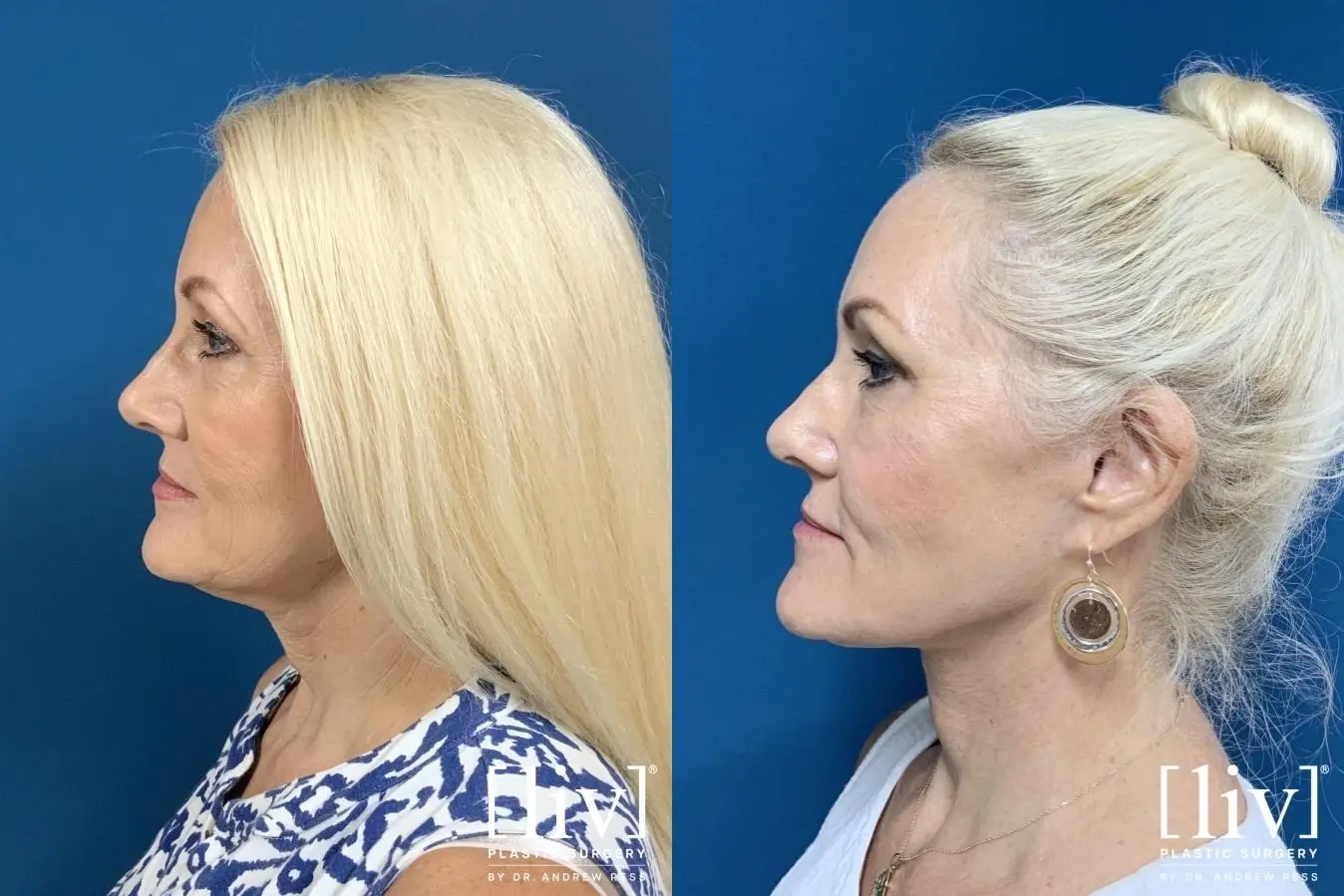 Facelift & Neck Lift: Patient 6 - Before and After 3