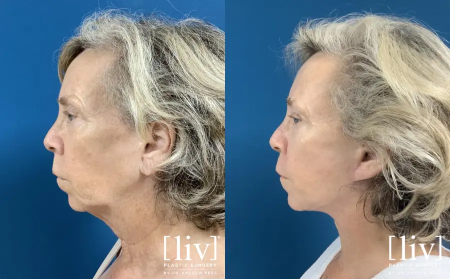 Facelift & Neck Lift with Fat Transfer - Before and After 3