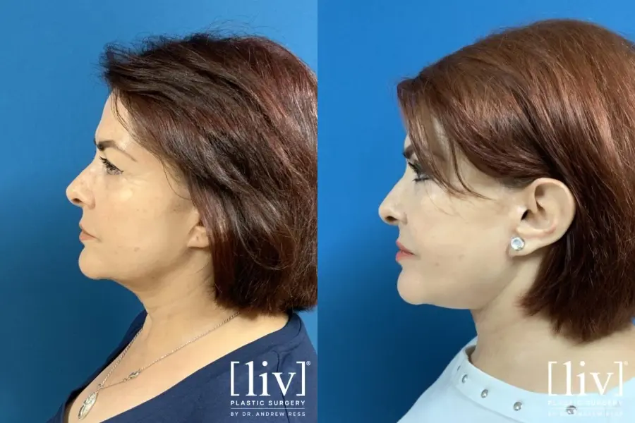 Facelift & Neck Lift: Patient 2 - Before and After 3