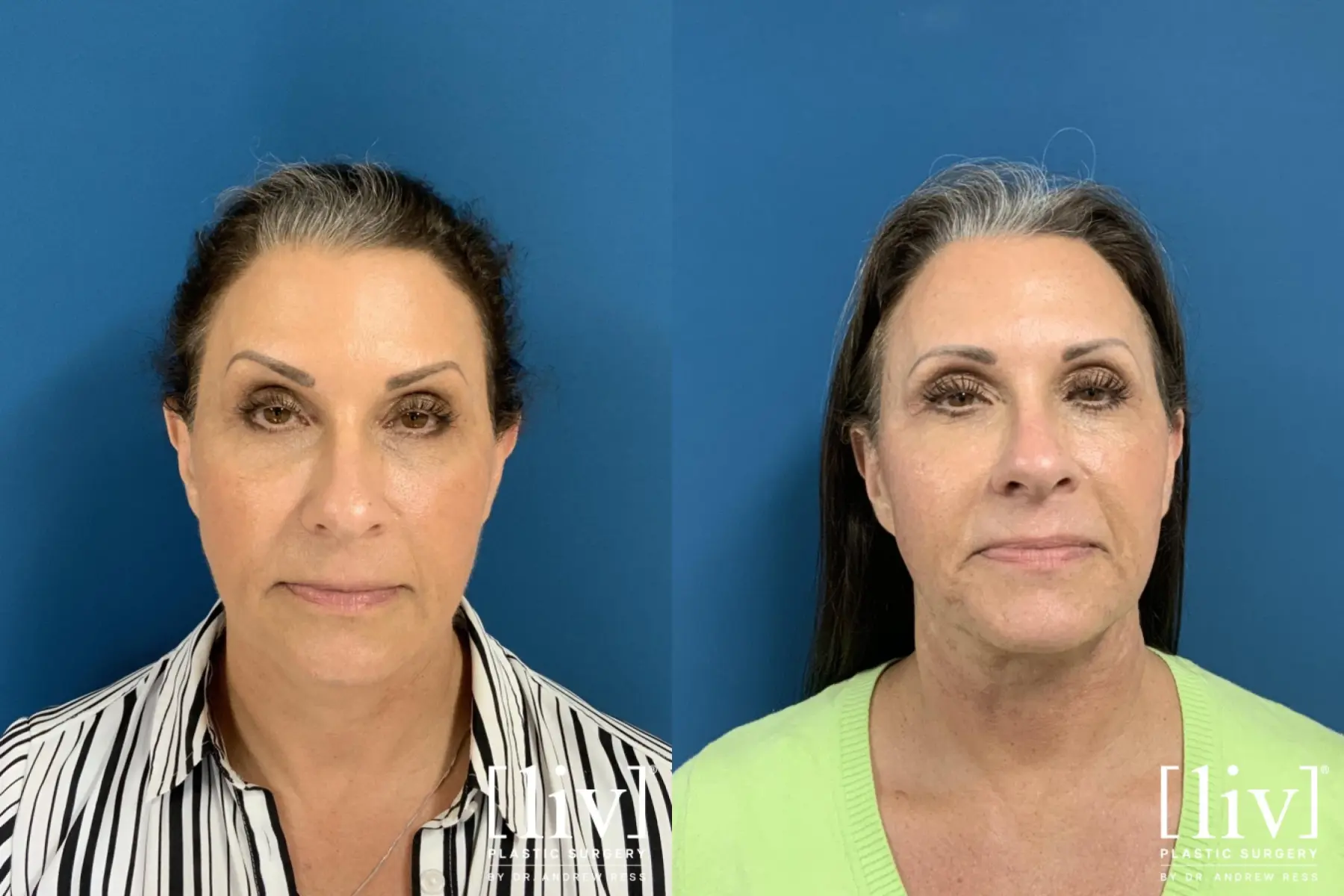 Facelift & Neck Lift: Patient 5 - Before and After  