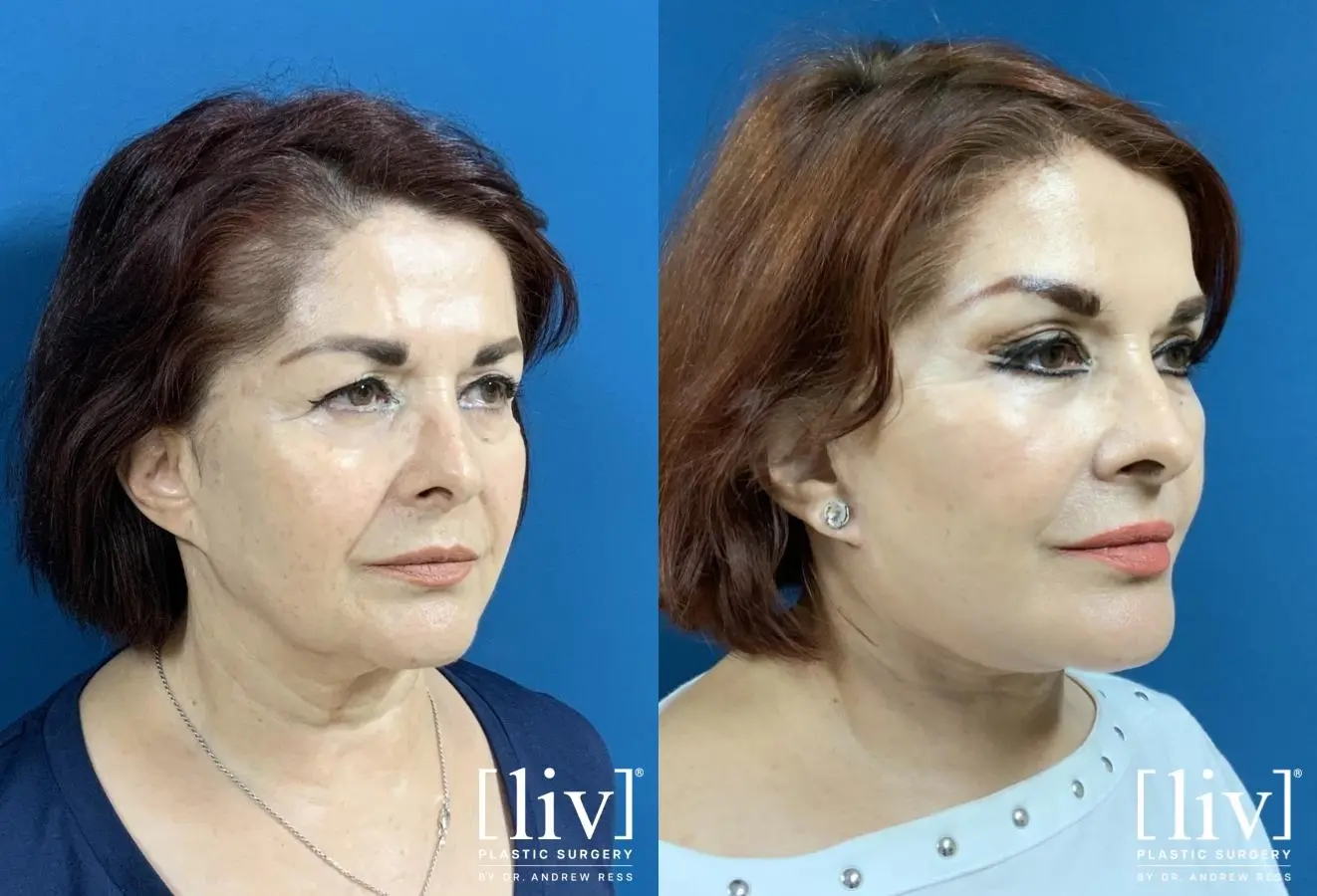 Facelift & Neck Lift: Patient 2 - Before and After 4