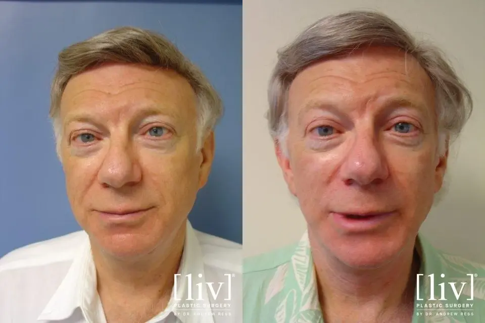 Facelift & Neck Lift: Patient 11 - Before and After 1