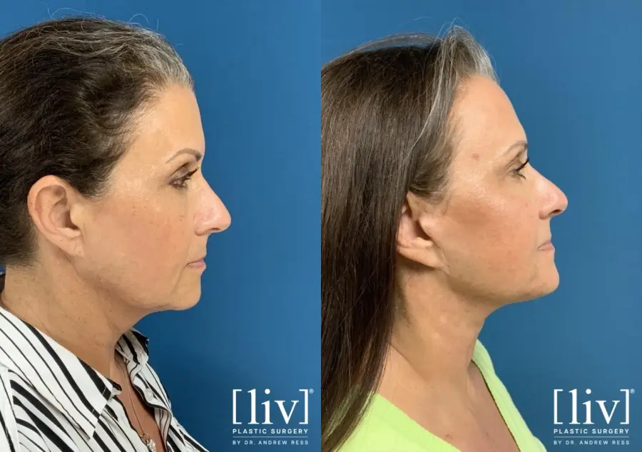 Facelift & Neck Lift: Patient 4 - Before and After 2