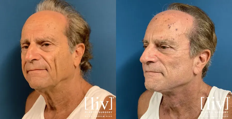 Facelift & Neck Lift: Patient 13 - Before and After 2