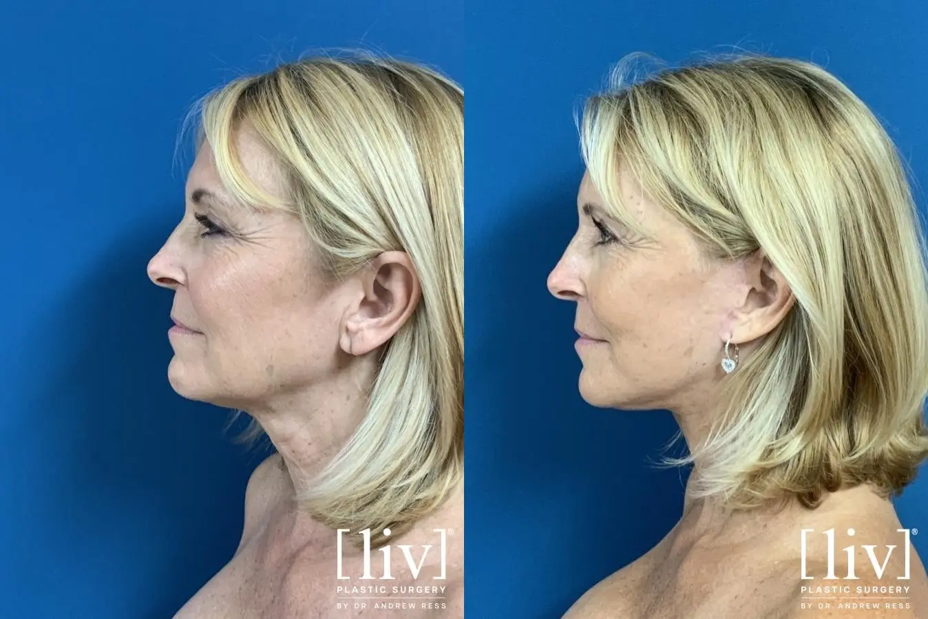 Facelift & Neck Lift: Patient 3 - Before and After 3