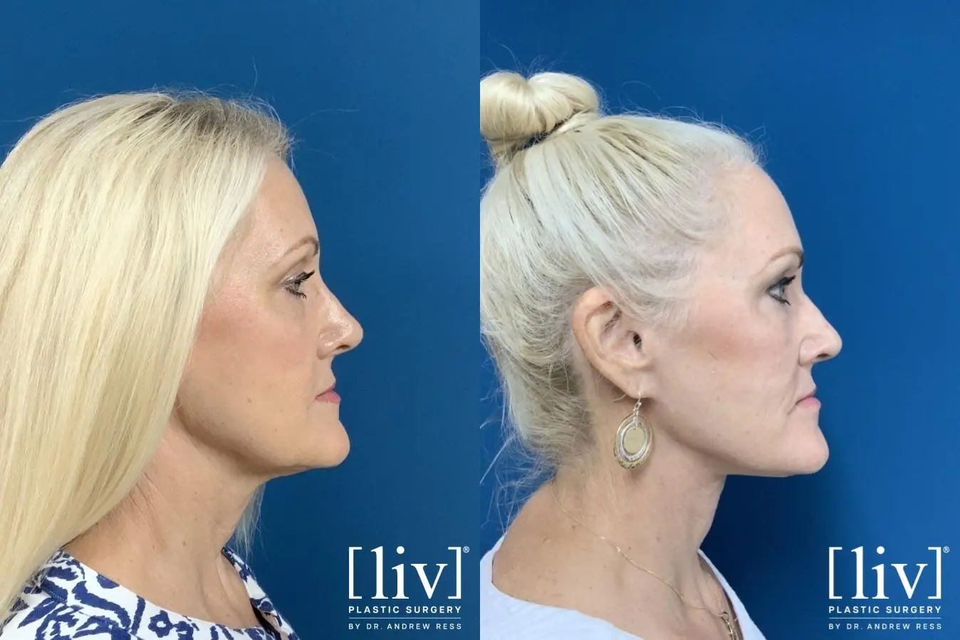 Facelift & Neck Lift: Patient 6 - Before and After 5