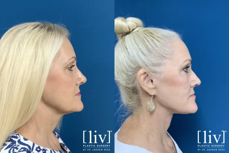 Facelift & Neck Lift: Patient 5 - Before and After 5