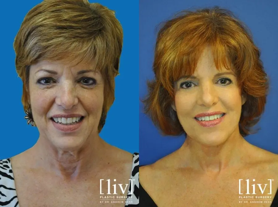 Facelift & Neck Lift: Patient 10 - Before and After 1