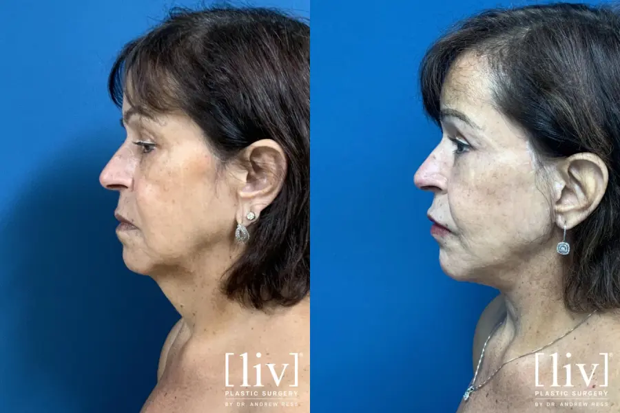 Facelift & Neck Lift: Patient 15 - Before and After 3