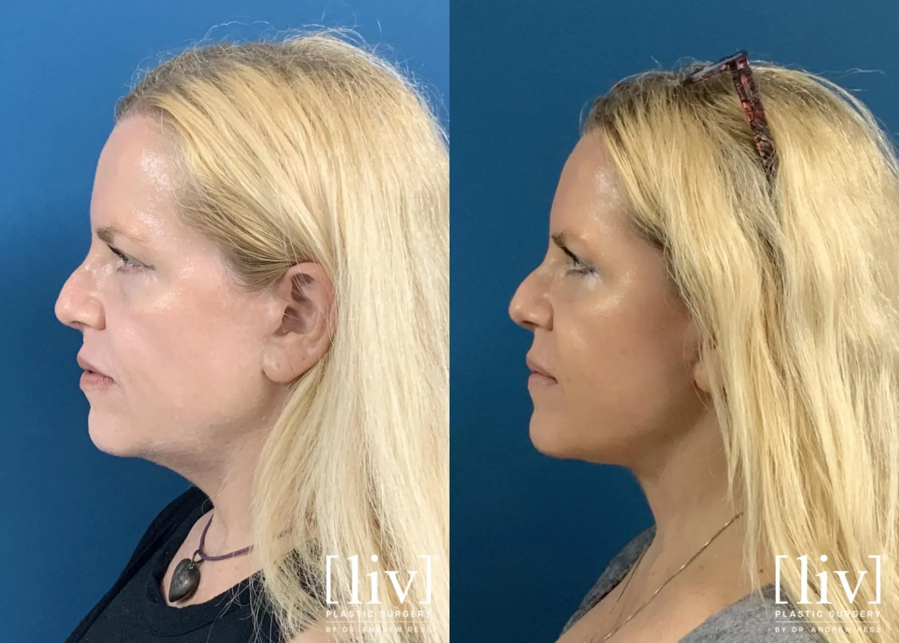 Facelift & Neck Lift: Patient 20 - Before and After 5