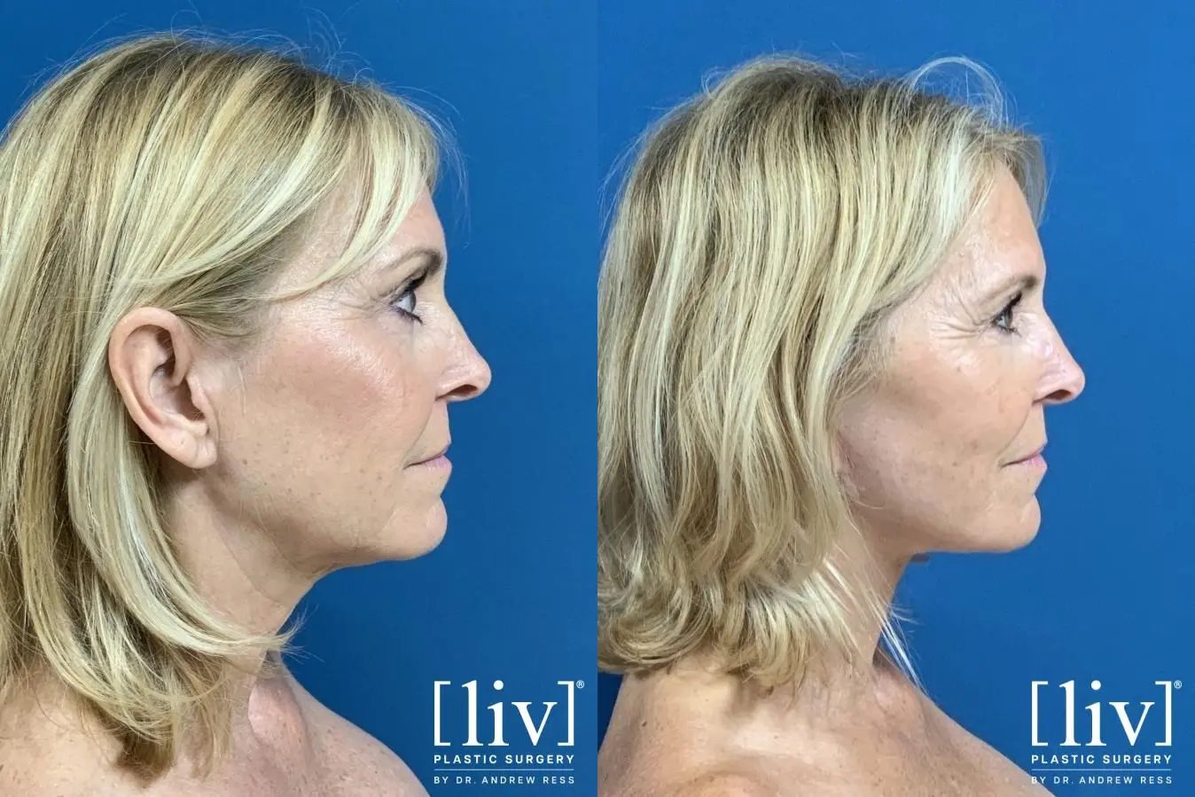 Facelift & Neck Lift: Patient 3 - Before and After 5