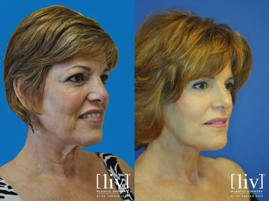 Facelift & Neck Lift: Patient 10 - Before and After 2