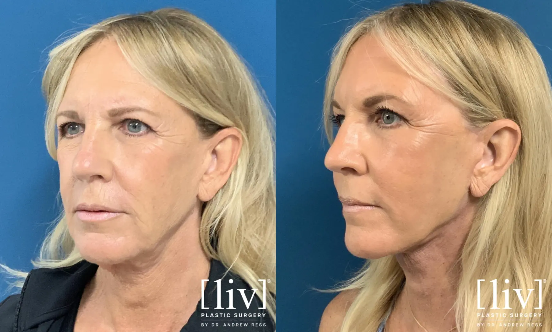 Face and Neck Lift with CO2 Laser - Before and After 2