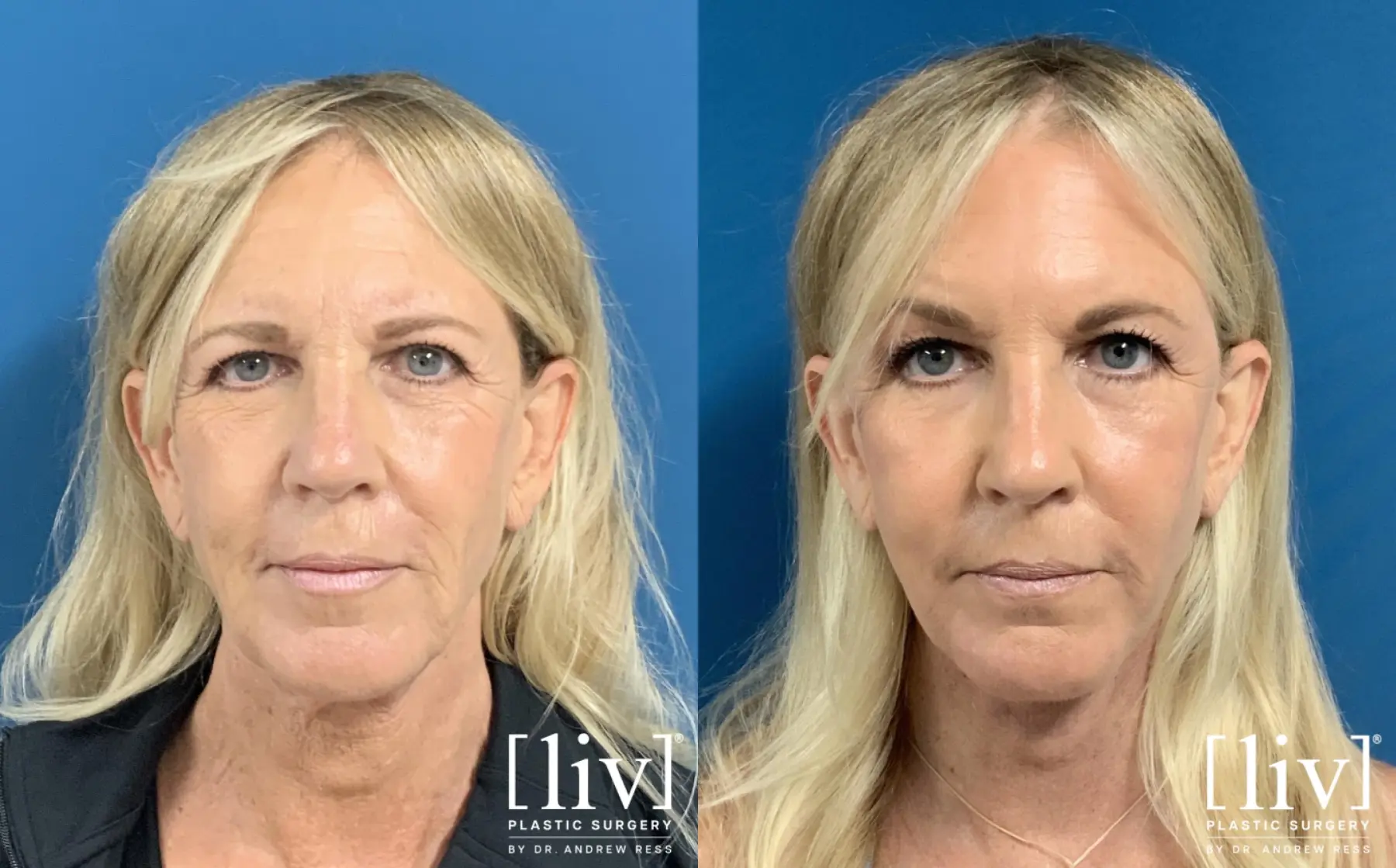 Face and Neck Lift with CO2 Laser - Before and After 1