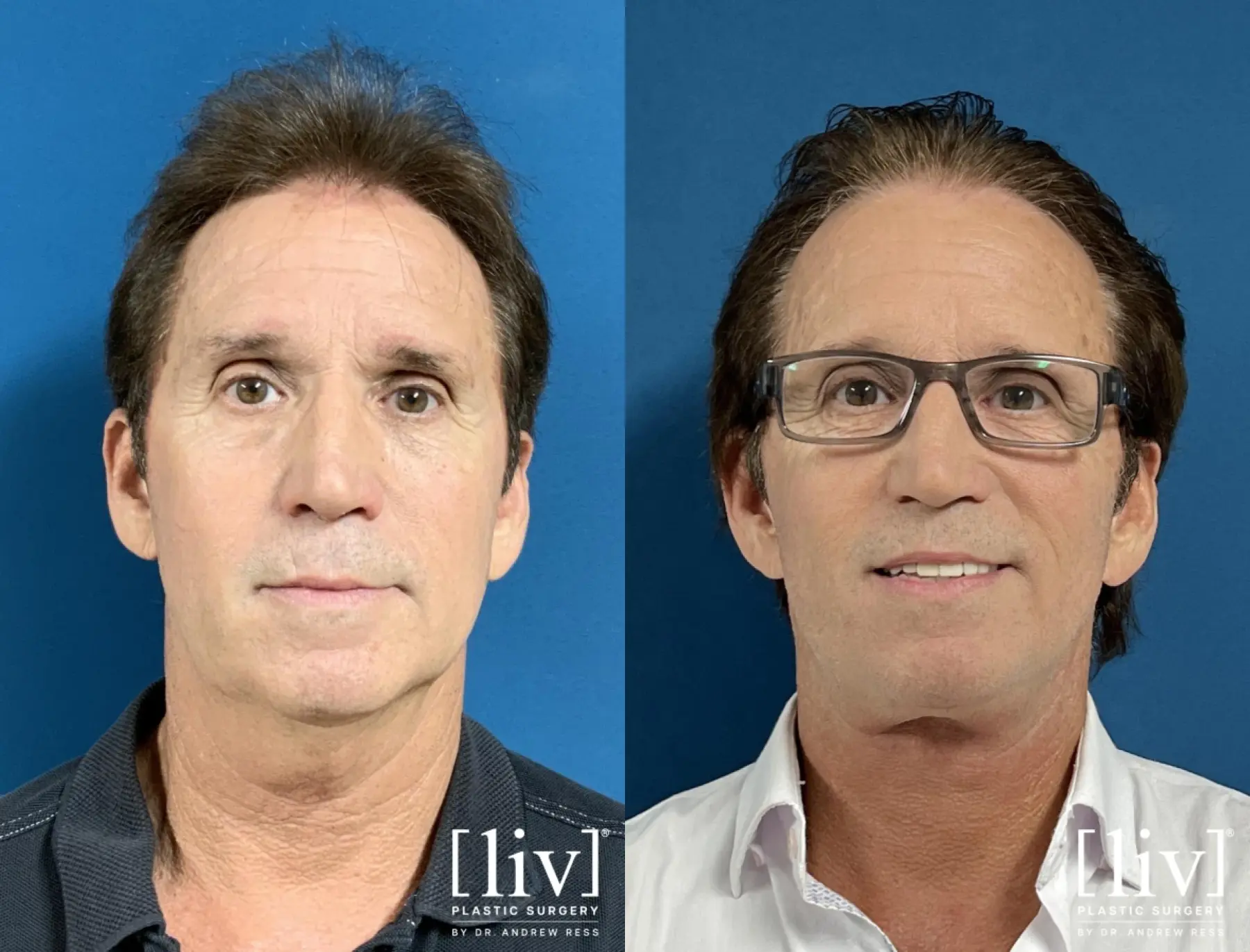 Neck Lift  - Before and After 3