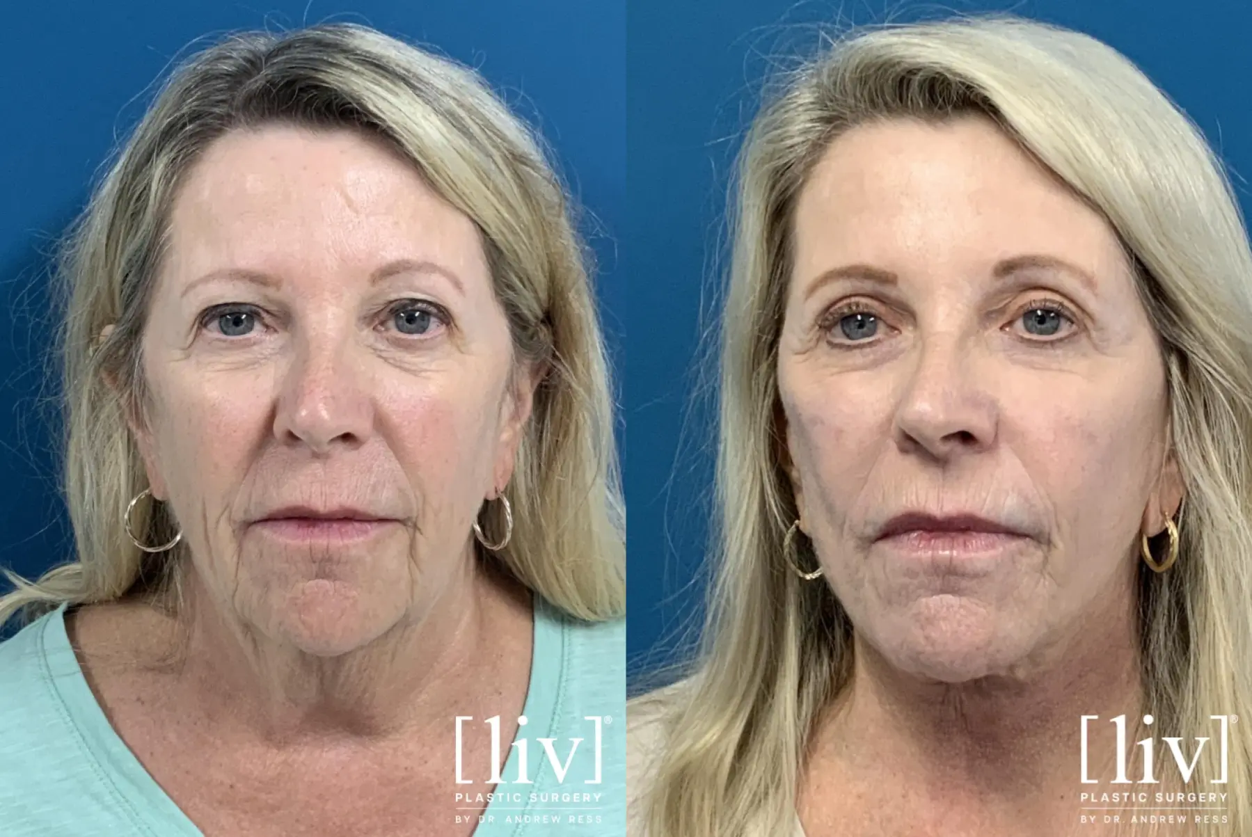 Face and Neck Lift, Co2 Laser, Fat Transfer, Upper Eyelid - Before and After 1