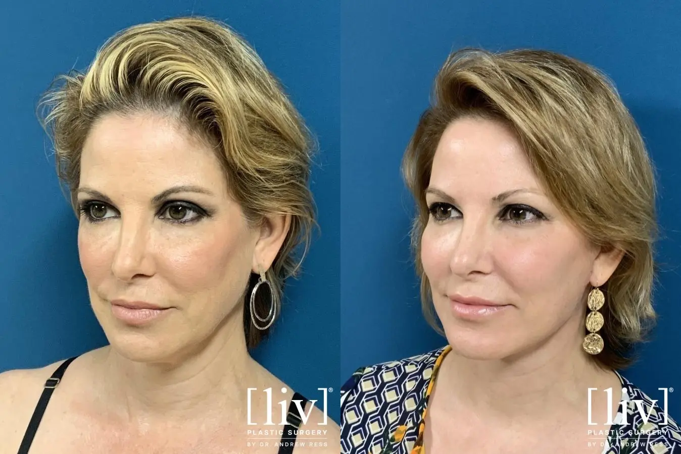 Facelift & Neck Lift: Patient 1 - Before and After 2