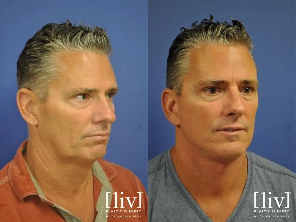 Facelift & Neck Lift: Patient 8 - Before and After 1