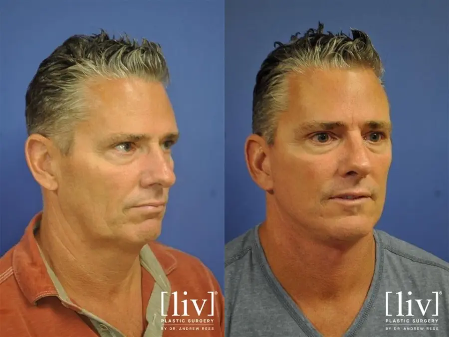 Facelift & Neck Lift: Patient 12 - Before and After 1