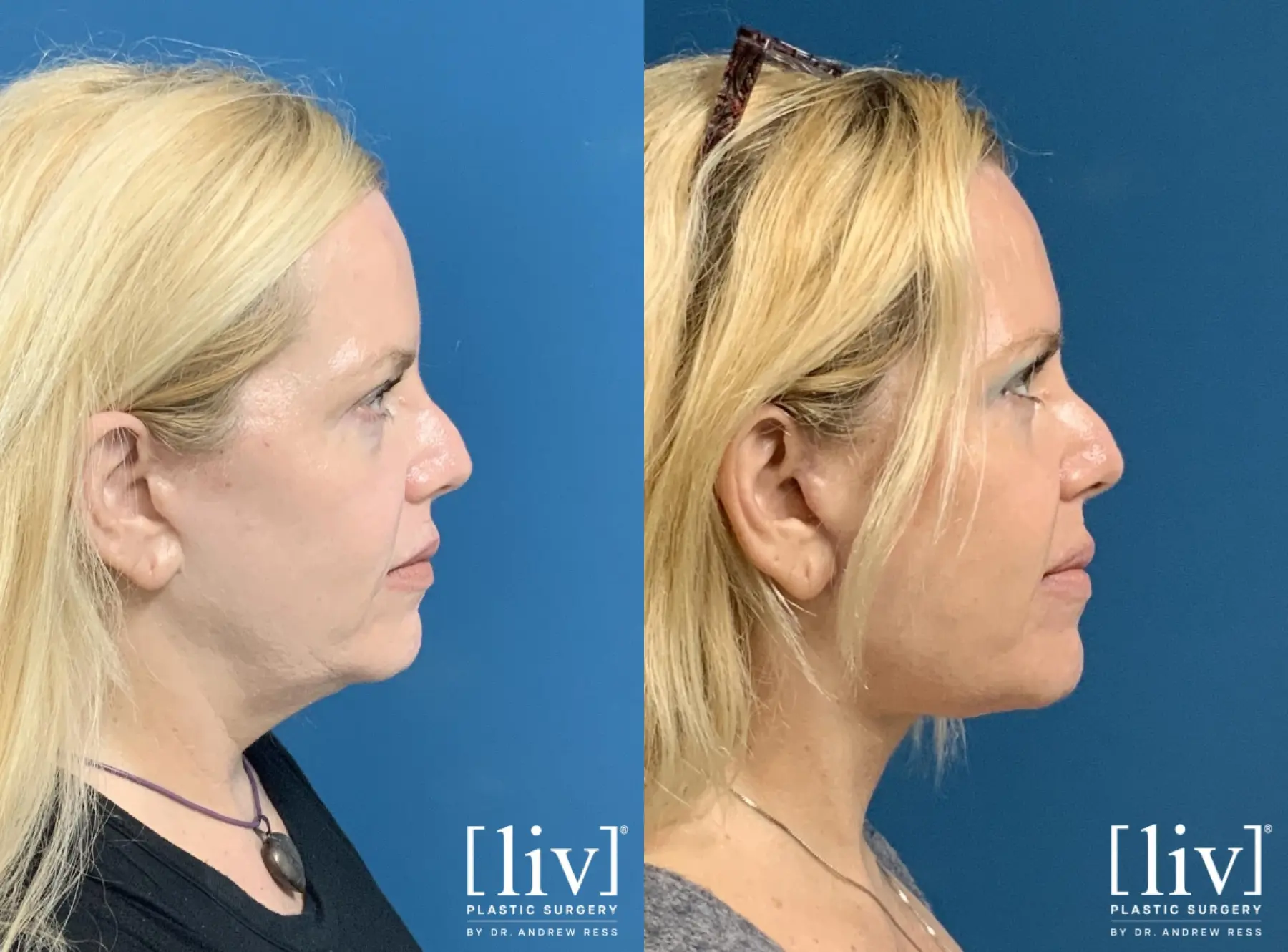 Facelift & Neck Lift: Patient 20 - Before and After 1