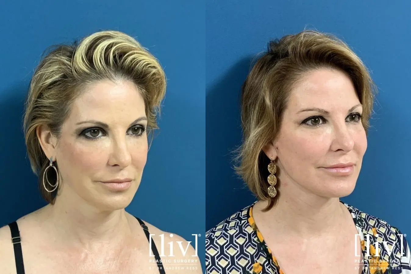 Facelift & Neck Lift: Patient 1 - Before and After 4