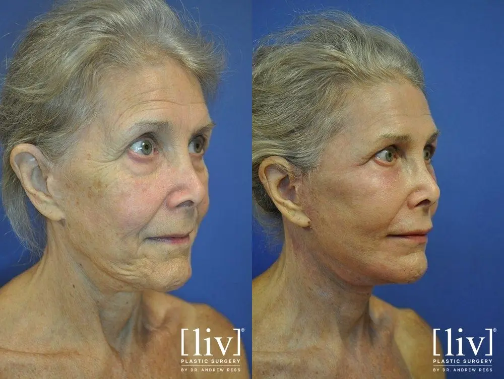 Facelift & Neck Lift: Patient 12 - Before and After 2