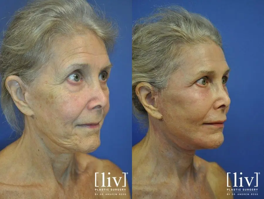 Facelift & Neck Lift: Patient 8 - Before and After 2