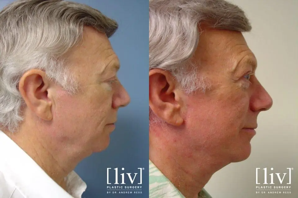 Facelift & Neck Lift: Patient 11 - Before and After 2