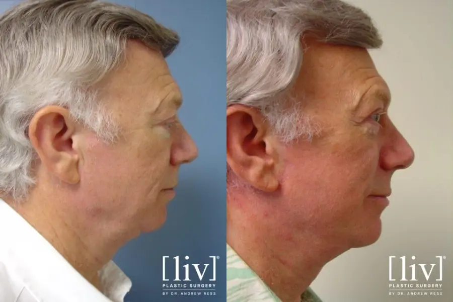 Facelift & Neck Lift: Patient 7 - Before and After 2