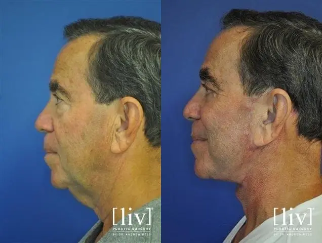 Facelift & Neck Lift: Patient 14 - Before and After 2