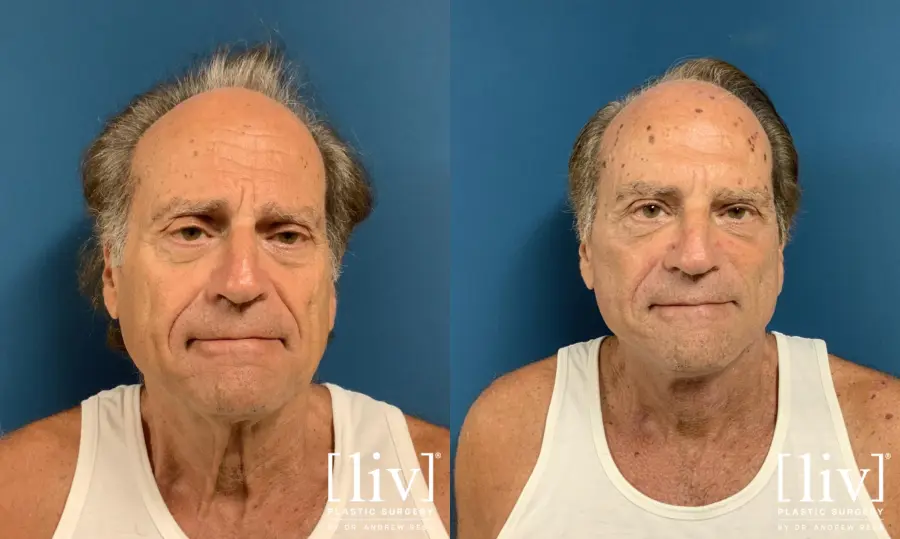 Facelift & Neck Lift: Patient 13 - Before and After 3