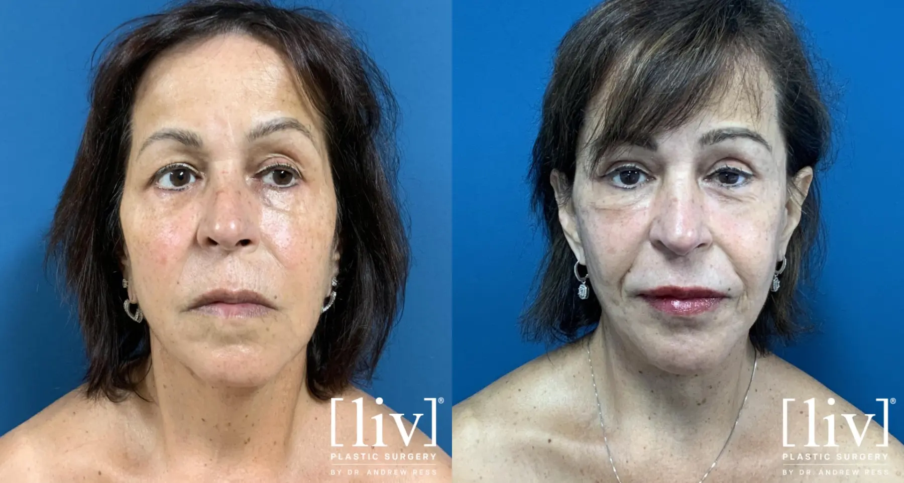 Facelift & Neck Lift: Patient 10 - Before and After 1